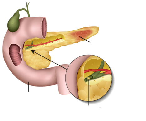 pankreatitt er en betennelse i bukspyttkjertelen